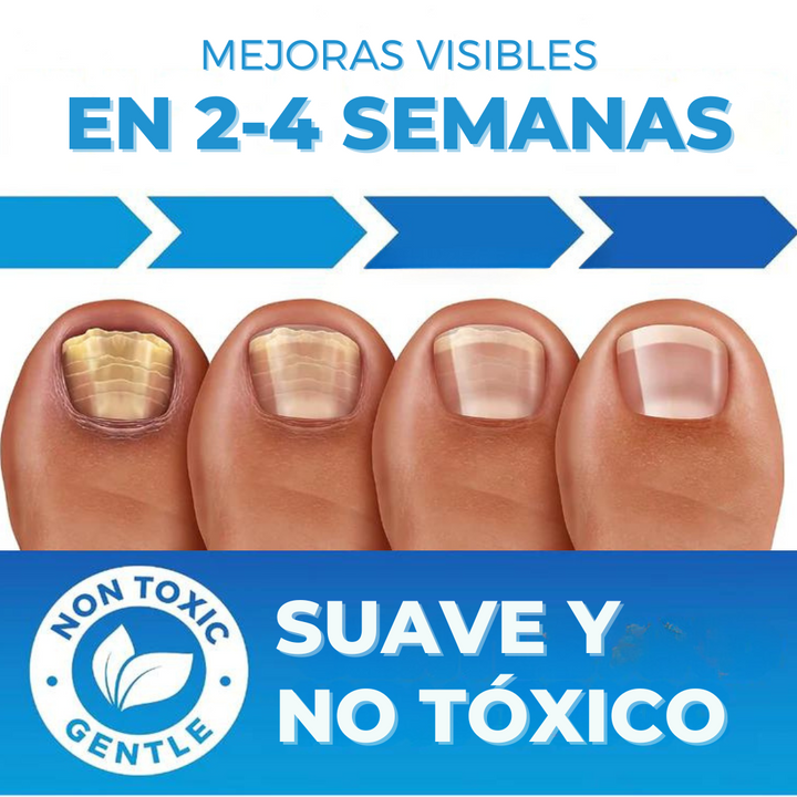 ¡3 KITS DE TRATAMIENTO DE HONGOS EN LAS UÑAS!