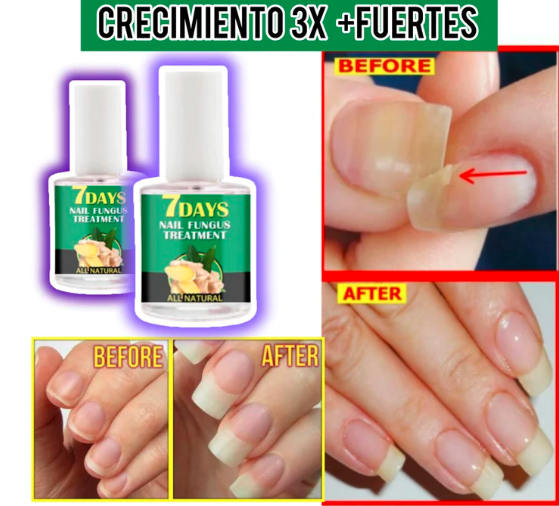 ¡3 KITS DE TRATAMIENTO DE HONGOS EN LAS UÑAS!